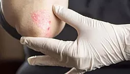 20 meilleurs remèdes contre le psoriasis