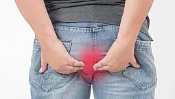 Top 10 des remèdes contre les hémorroïdes