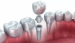 10 najboljih klinika za dentalne implantate u Moskvi