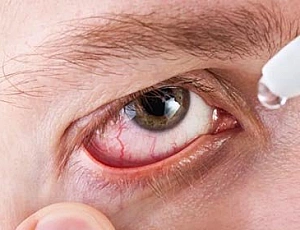 15 najboljših kapljic za konjunktivitis