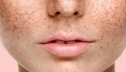 15 התרופות הטובות ביותר לכתמי גיל בפנים