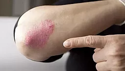 5 legjobb vitamin pikkelysömörre