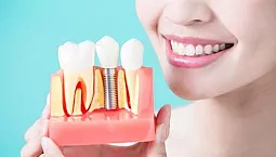 5 bästa implantattillverkarna