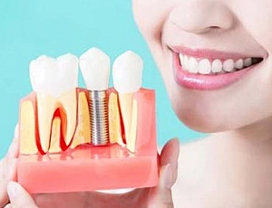 5 bästa implantattillverkarna