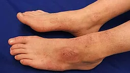 15 Ubat Ekzema Terbaik