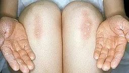 10 mejores remedios para el liquen