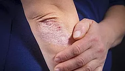 10 cele mai bune remedii non-hormonale pentru psoriazis