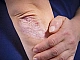 10 labākie nehormonālie līdzekļi psoriāzes ārstēšanai