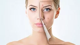 10 mejores remedios para las cicatrices del acné