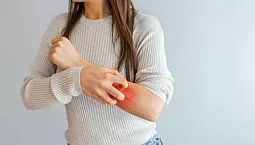 10 התרופות הטובות ביותר לדרמטיטיס עם iHerb