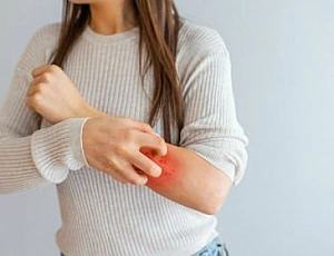 10 best remedies for dermatitis with iHerb