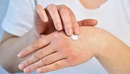 10 cele mai bune remedii pentru psoriazis cu iHerb