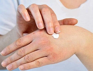 10 legjobb gyógymód pikkelysömörre az iHerb segítségével