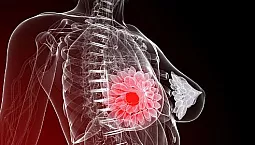 10 ubat terbaik dengan iHerb untuk rawatan mastopati