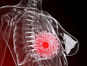 10 legjobb gyógymód az iHerb-el a mastopathia kezelésére