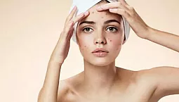 iHerb ile En İyi 10 Akne Tedavisi