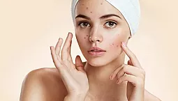 10 ungüentos más efectivos para el acné