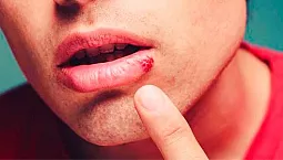 10 cele mai eficiente unguente pentru herpes