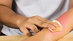 Top 20 de remedii pentru arsuri