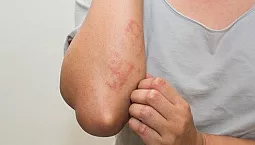 10 labākie neirodermīta līdzekļi