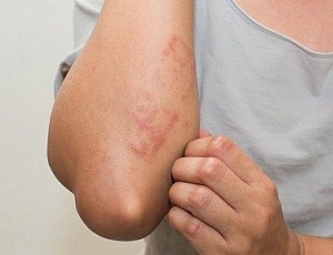 10 najboljših zdravil za nevrodermatitis